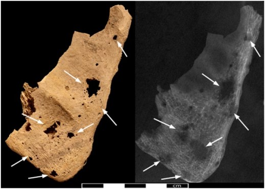 Lesioni tumorali sulla scapola destra del giovane di Amara West