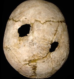 Cranio trapanato, proveniente dal dolmen, di individuo sopravvissuto all'operazione